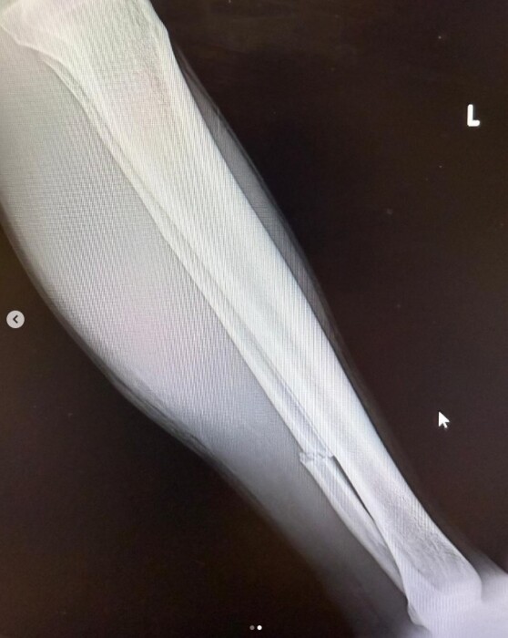 Eli Tomac broken fibula - blucruofficial Instagram.jpg